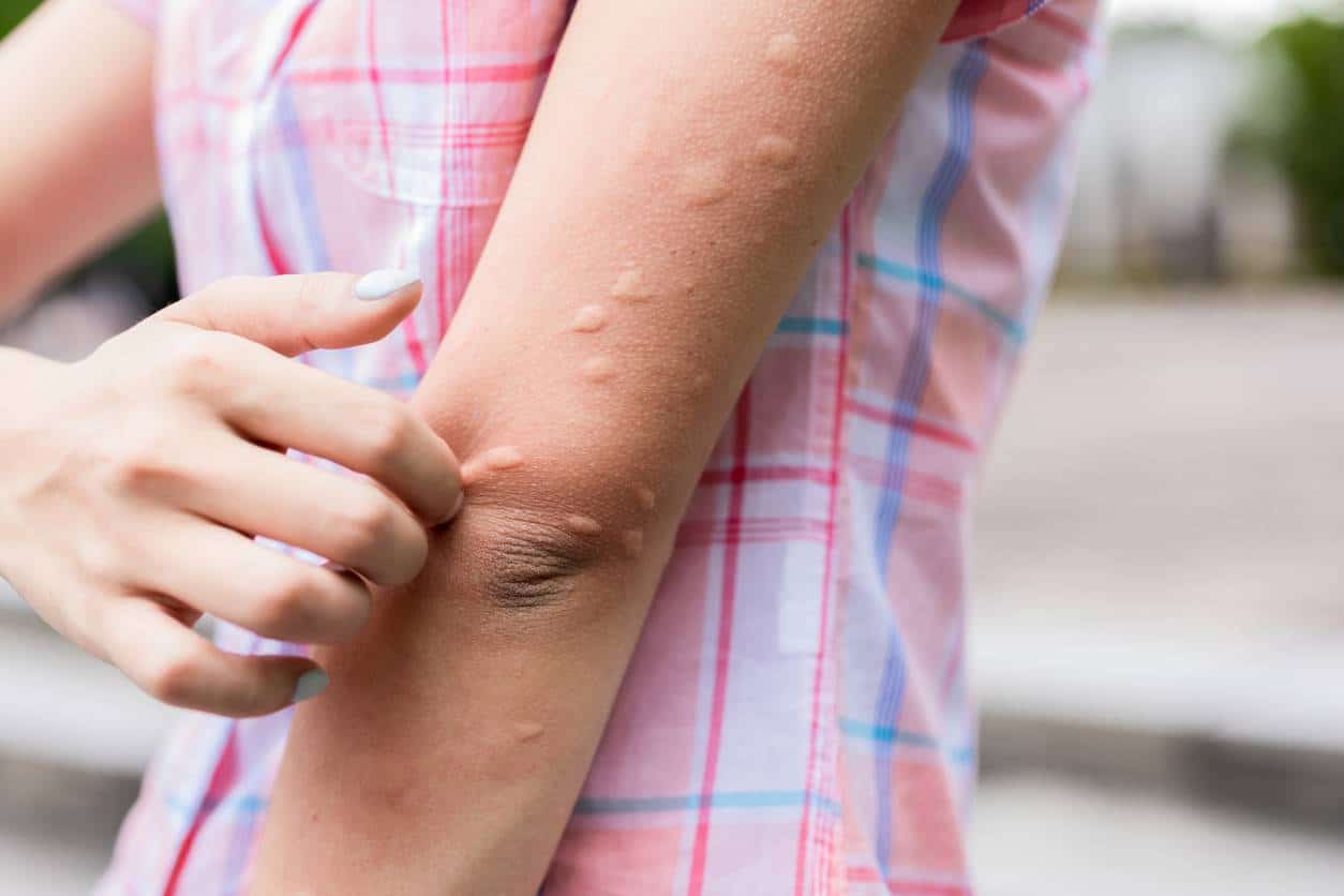 Moustiques : comment ne plus subir les attaques !